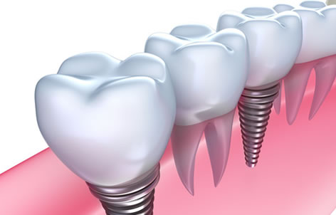 What are mini dental implants?