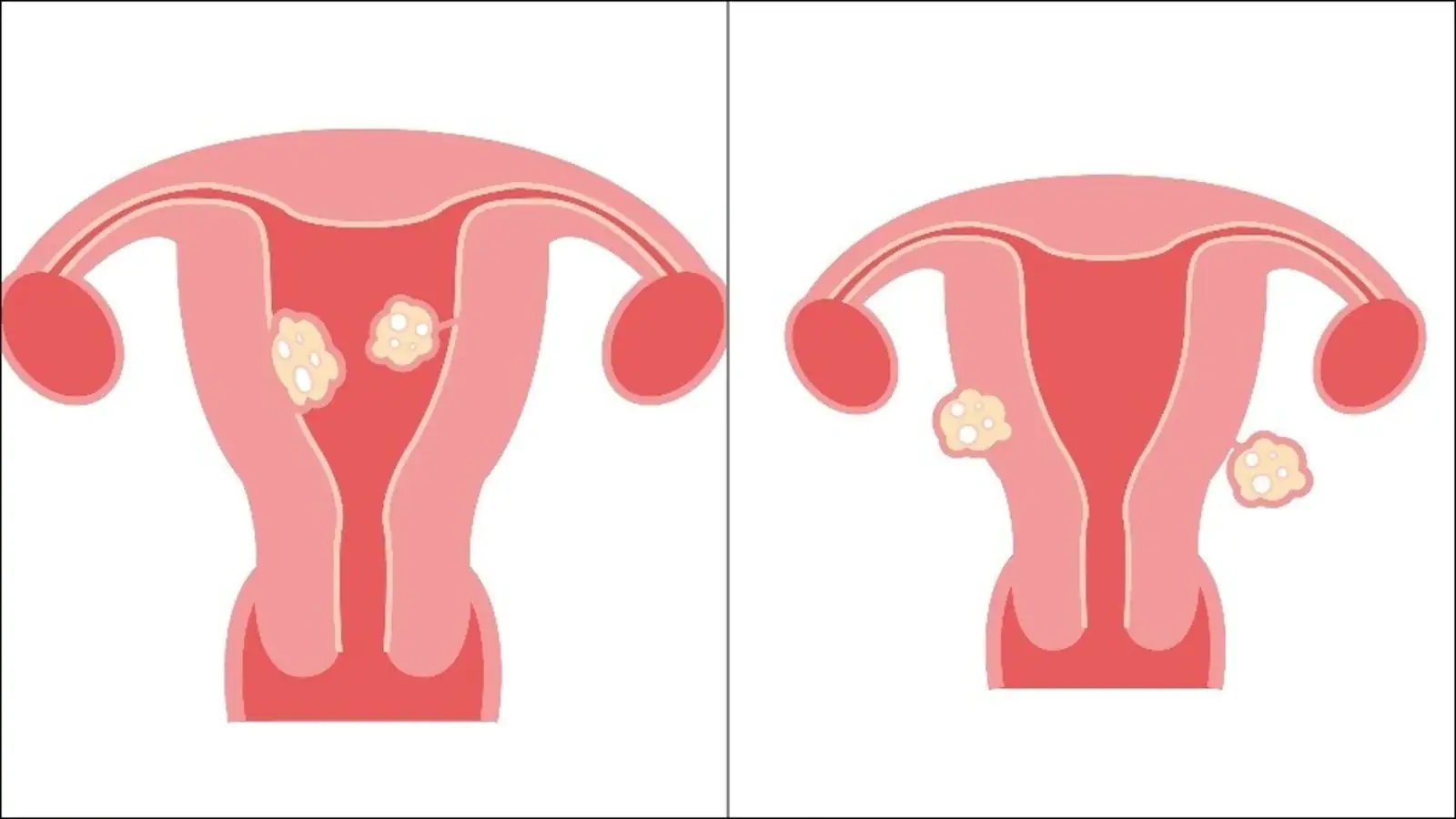 Battling Fibroids: 7 Things That Can Help Manage the Symptoms