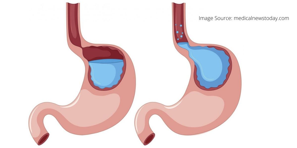 Planning for a Reflux Surgery: Things to Consider for a Successful Operation
