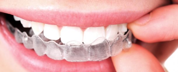 <strong>6 Reasons Why Invisalign Outshines Braces</strong>