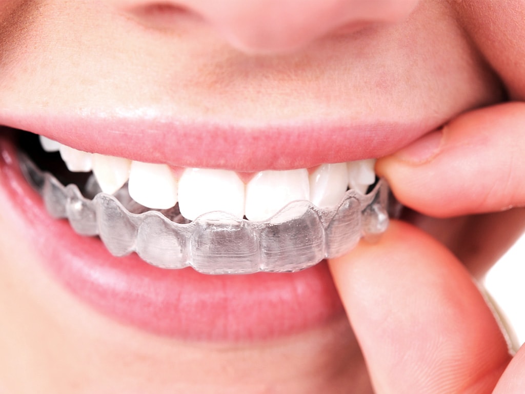 6 Reasons Why Invisalign Outshines Braces