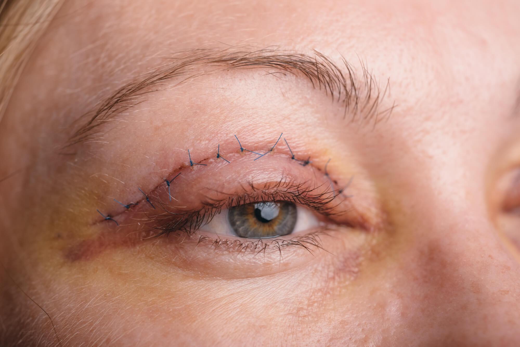 Eyelid Lift Recovery: What to Expect
