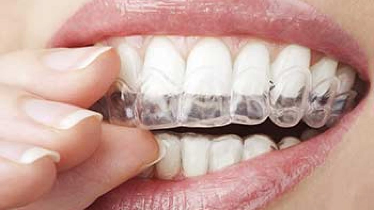 6 Reasons To Choose Invisalign