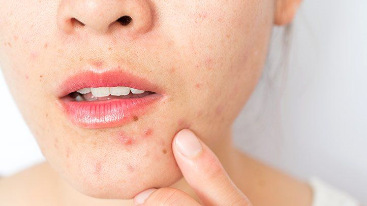 Acne Causes – What Causes Acne?